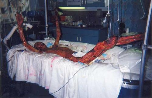 22年前的核辐射受害者,持续治疗83天无果,眼睁睁看着自己死亡