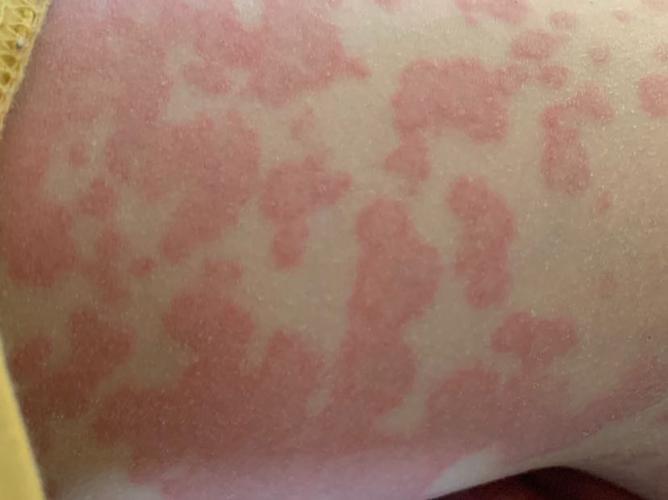 多形红斑是怎么一回事?