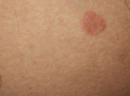 求专家看看这是什么皮肤癣一圈凸起偶尔痒,该怎么治疗