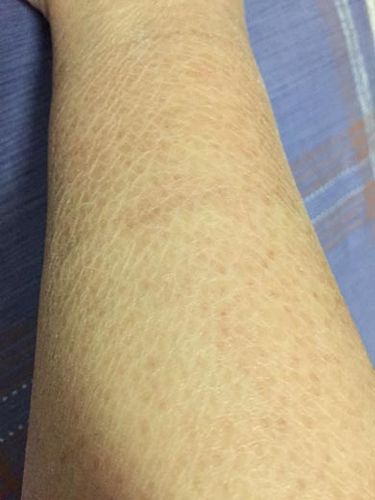 > 皮肤科 > 鱼鳞病 > 饮食