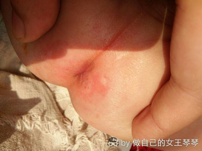 有谁知道宝宝屁股淹破怎么弄?