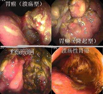 四道科普你或熟悉的他和她风华正茂却因胃癌离世专家提醒别让它如此