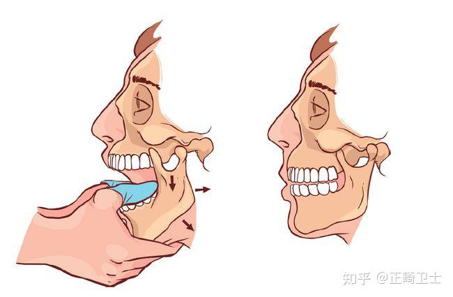 关于"下巴脱臼"你知多少?