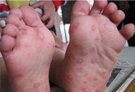 各种疹子的症状图片 详细介绍各种疹子的特点