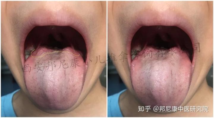 孩子鼻甲肥大,腺样体肥大,上颌窦炎全都有!