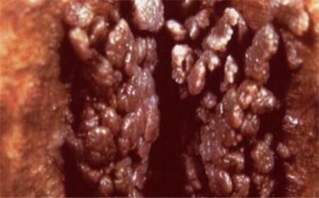 乳头像菜花一样正常吗