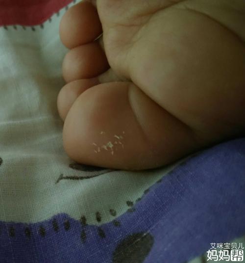 宝宝大脚趾有倒刺