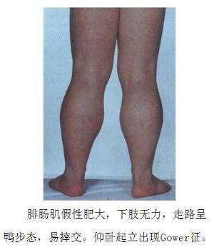 3岁韬韬小腿肌肉发达,但是医生却说