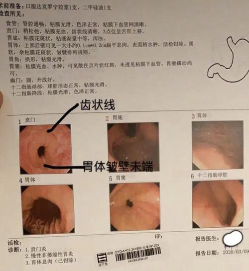 胃体皱襞末端与齿状线之间似乎有一定距离,橘红色的黏膜,似有barrett