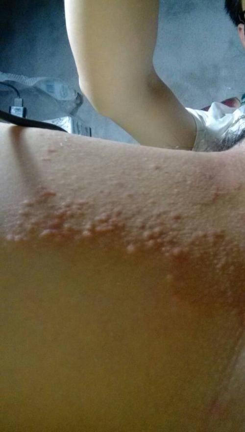 大腿内侧长了很多红点,而且很痒怎么办