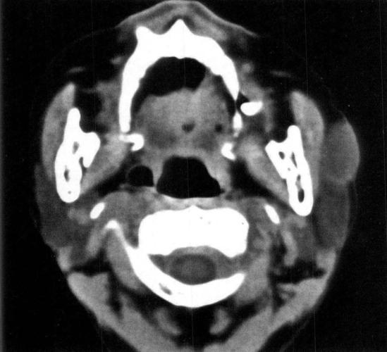 颌面颈部疾病影像学图鉴 正文   图22-1-4 左面颊部表皮样囊肿  女性