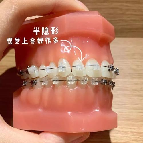 大连齿医生口腔科普想矫正又不知道怎么选牙套点这里