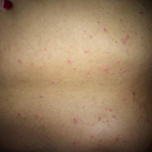 我对象说这是热毒到我看着不像,请问有谁知道这是起的什么疙瘩吗?