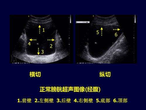 医学超声影像学膀胱超声ppt