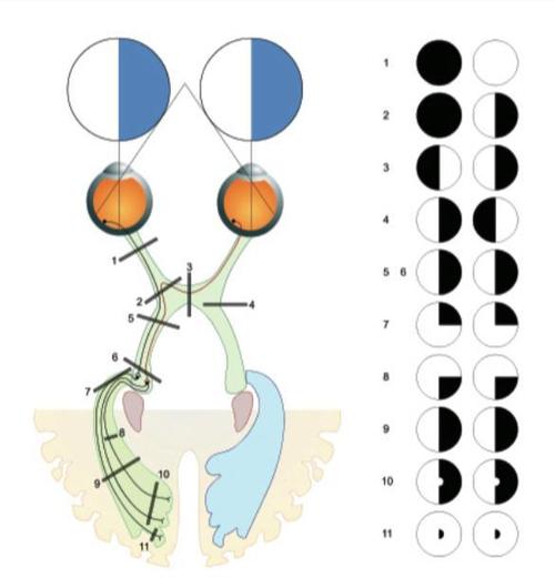 左颞侧视野-左眼鼻侧视网膜-视交叉内侧(并交叉到对侧)-右侧视束-右侧
