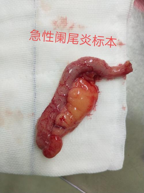鼠年第一刀:阑尾切除术