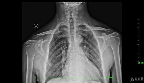 求助,各位老师看看是否肩锁关节脱位?