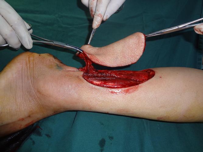 游离腓动脉穿支皮瓣