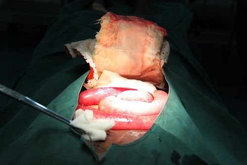 (裂开的伤口,肠子已经膨出腹外.)