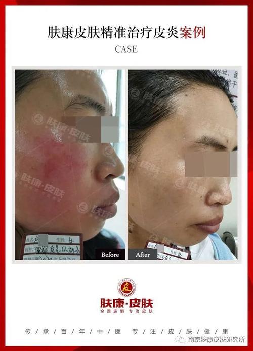 面部皮炎案例视频图面部皮炎怎么治疗好得快