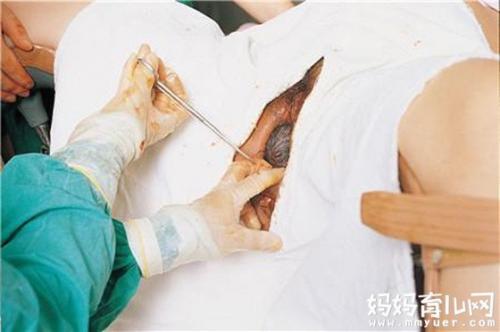 一组女人顺产侧切伤口图片 看得我胆战心惊!