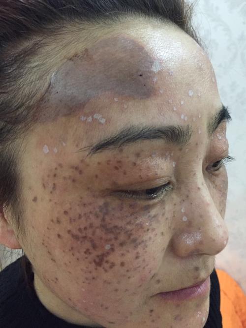 伊莲祛斑 天下无斑 片状真皮斑操作提取 后续还有视频讲解操作提取