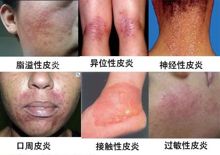 医生解析皮炎的症状及治疗方法