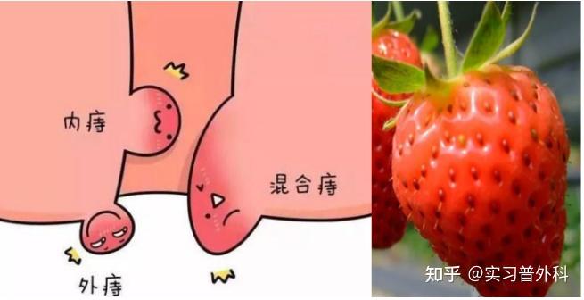 脱垂感:明显感觉到菊花里的肉球往外坠,仿佛屁股上挂着一个秤