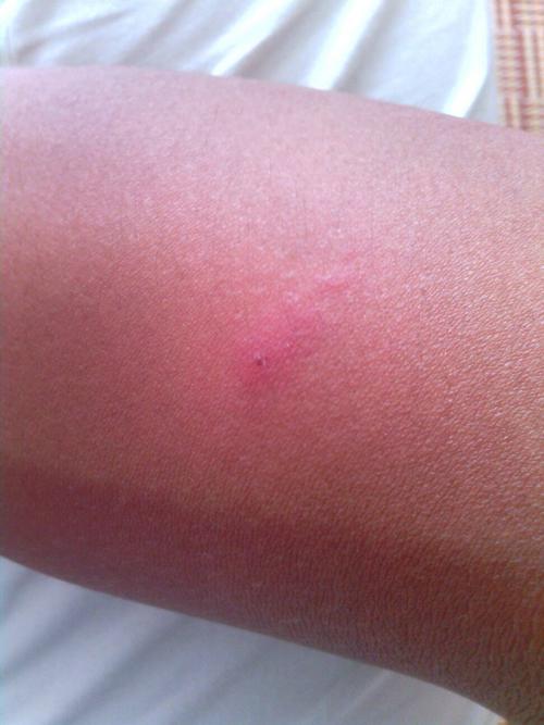 身上很多这种包什么情况?