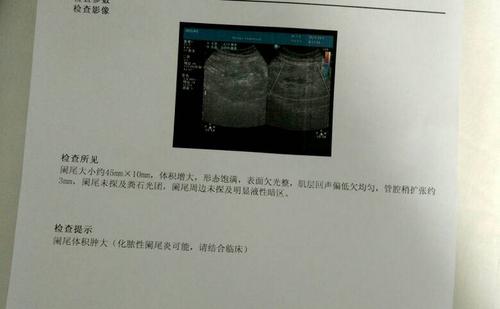 粪石阑尾炎微创还是开刀