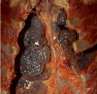 肺气肿治疗的好方法