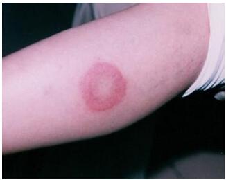 什么叫红斑狼疮