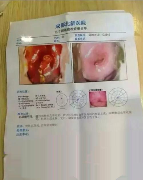 宁密康--宫颈纳氏囊肿案例