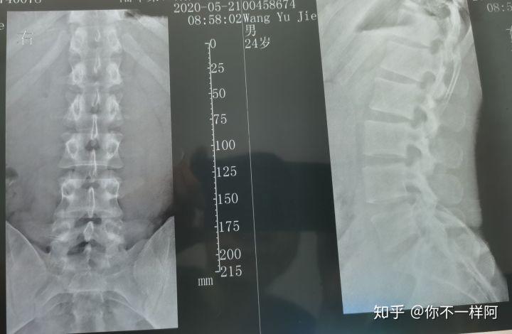 走路久了就会感到腿会麻木,要抬腿才能感受到,尾椎骨一直疼痛?
