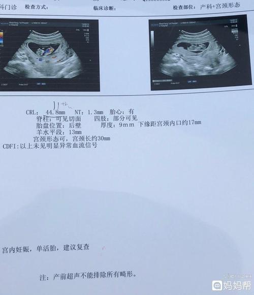 十一周b超,有宝妈会看男女吗?