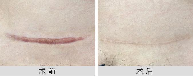 【三甲医生解析】剖腹产疤痕增生怎么办?