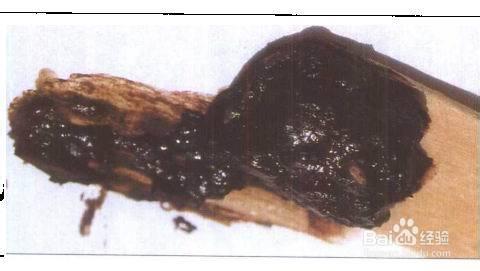 则有肝硬化病史及肝硬化的临床表现; 3 呕血和黑便:凡出血后因血液