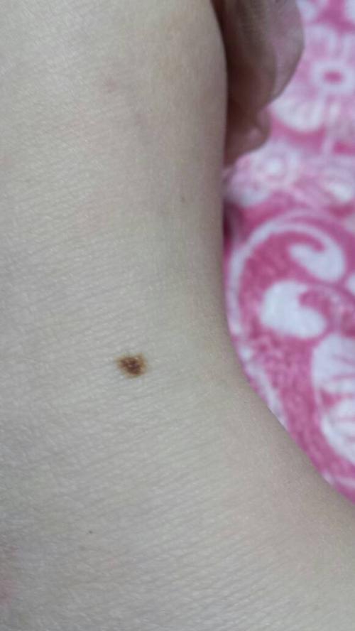 约3毫米,大小没有明显变化,痣中间深边缘淡,其他反应没有,像这种情况