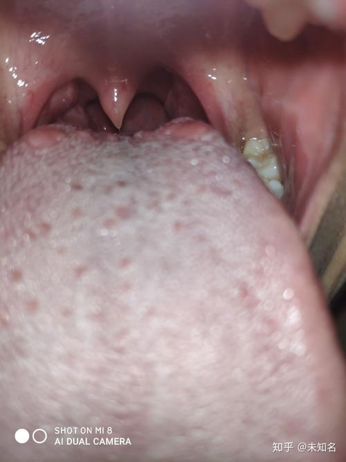 嗓子干舌根起泡,难受不发声嗓子发红