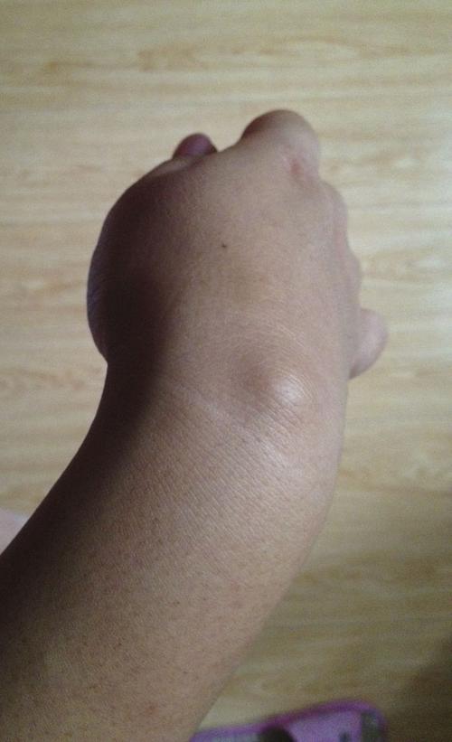 手腕上长了个包,网上搜了一下,好像是腱鞘炎,目前不痛不痒,需不需要去