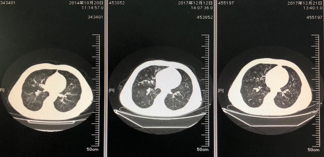 其它 树芽征 写美篇 桶状胸,双肺闻及哮鸣音,左下肺闻及湿啰音. 2017.