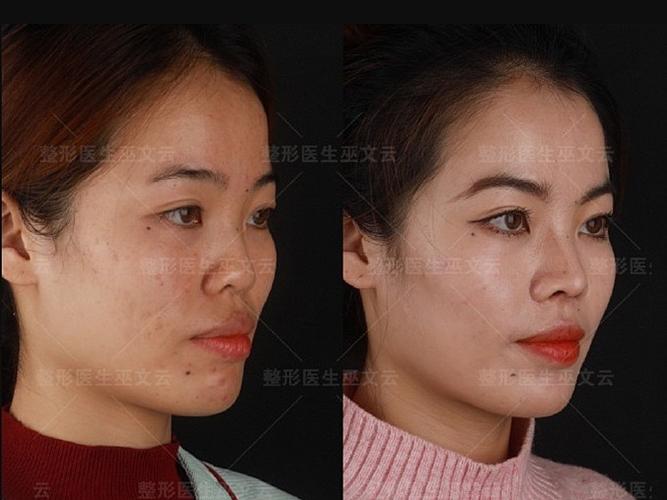 对于塌鼻来说,鼻背垫高就有不错的效果