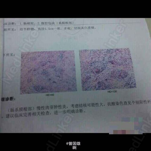 肠结核一例