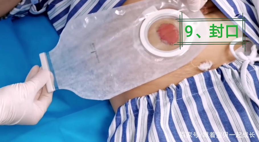 造瘘袋 - 热门商品专区