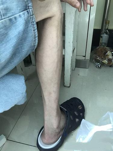 男孩患暴食症骨瘦如柴,一顿吃200个饺子后狂吐不止,跪求医治