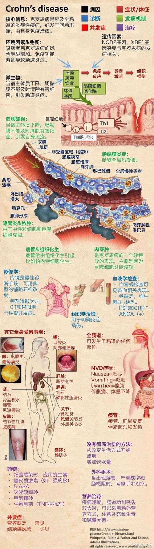 图解:克罗恩病
