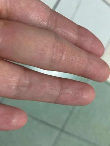 手指上长疱疹_疱疹_医疗健康_医疗健康其他