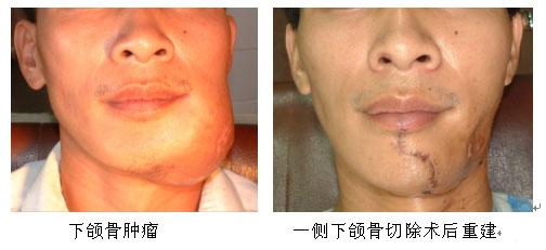 下颌骨肿瘤的治疗病例