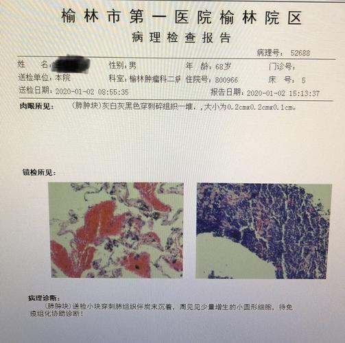小细胞肺癌诊断与全身评估