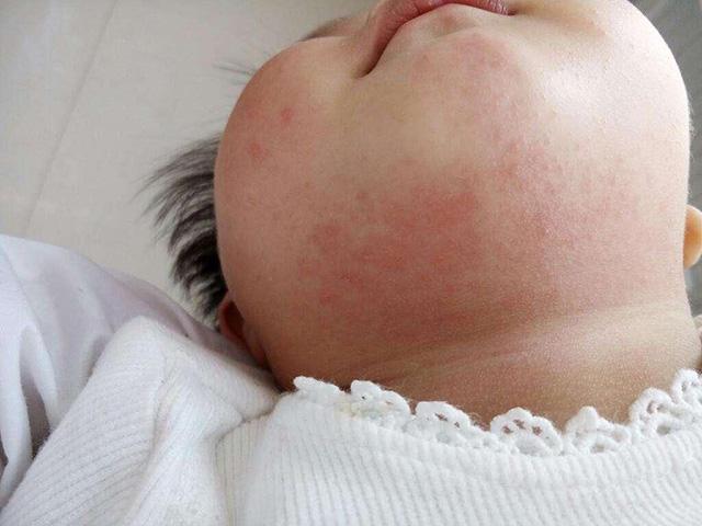 原创宝宝患婴儿湿疹是怎么回事若父母无过敏史这些原因要一一排除